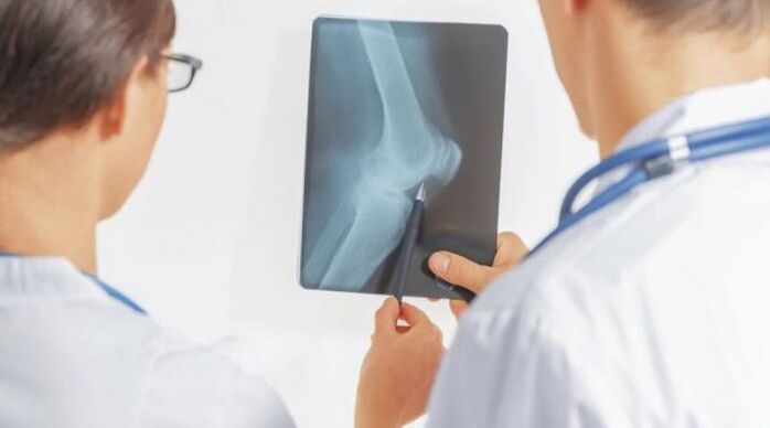 After the necessary diagnosis of arthrosis of the knee joint, doctors prescribe complex treatment
