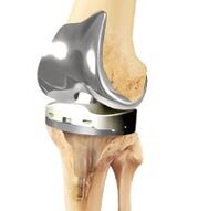 Joint prostheses