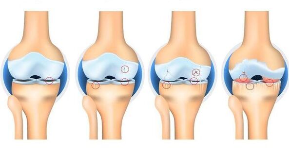 Phase of osteorthrosis