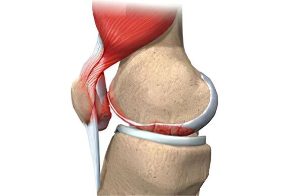 Complications of osteoarthritis
