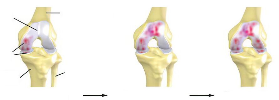 Osteoarthritis phase