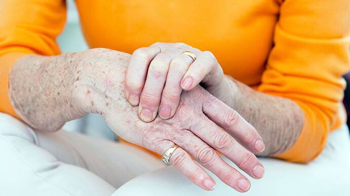Arthrosis of the brush