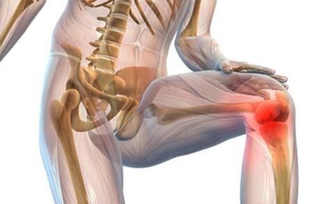 Arthrosis of the knee joint