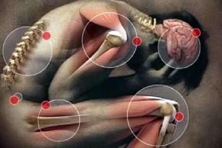 Arthrosis