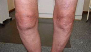 symptoms of osteoarthritis