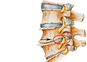 Causes of cervical osteochondrosis