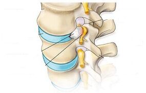 main symptoms of cervical osteochondrosis