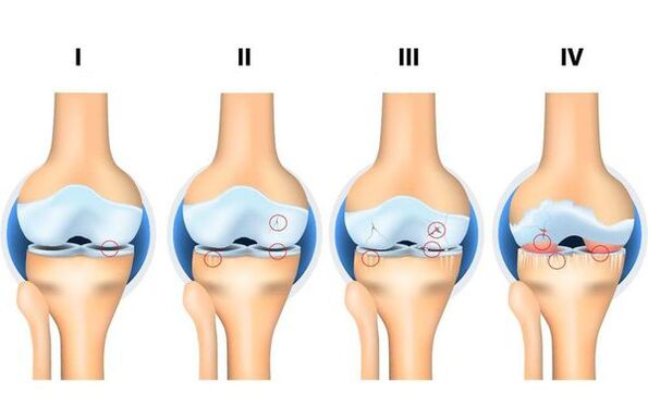 Development stages of osteoarthritis